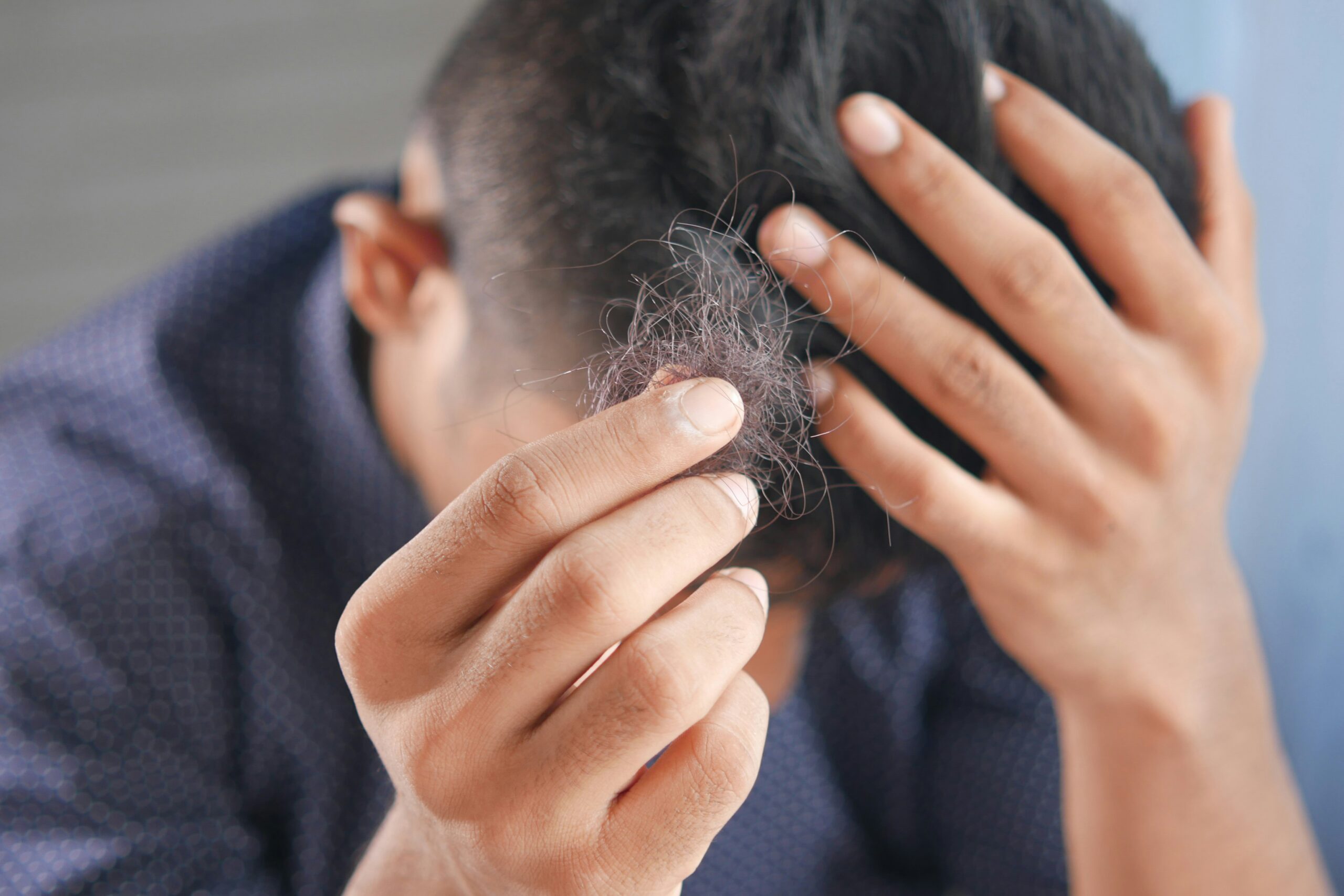 Male Pattern Baldness Exposed: Secrets Every Man MUST Know